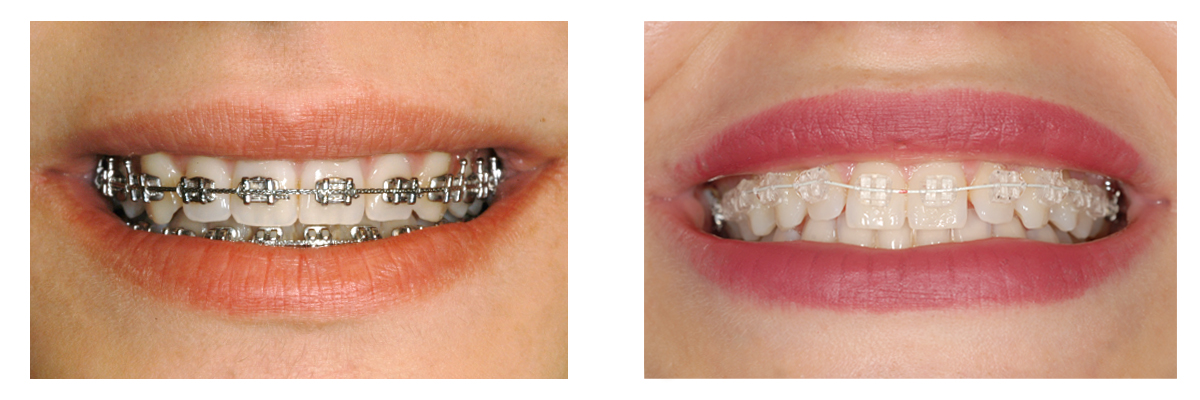 Allineare i denti nei pazienti adulti: comparazione attacchi estetici