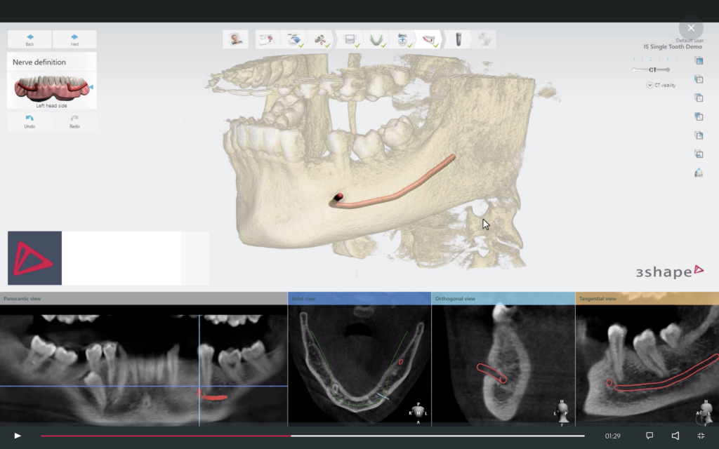 Radiografia e TAC al computer implantologia guidata
