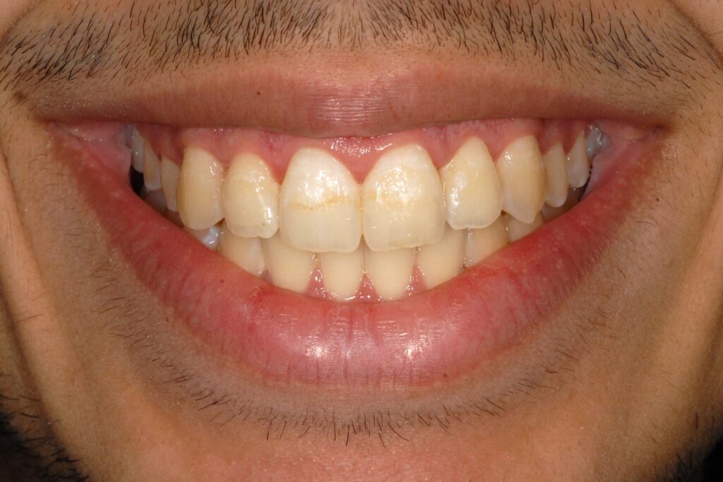 White spots: risultato finale con ortodonzia e trattamento remineralizzante al fluoro in office e domiciliare