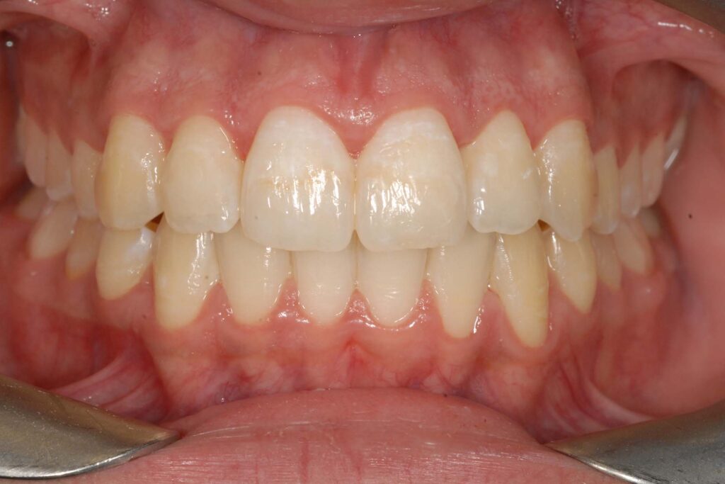 White spots: risultato finale con ortodonzia e trattamento remineralizzante al fluoro in office e domiciliare