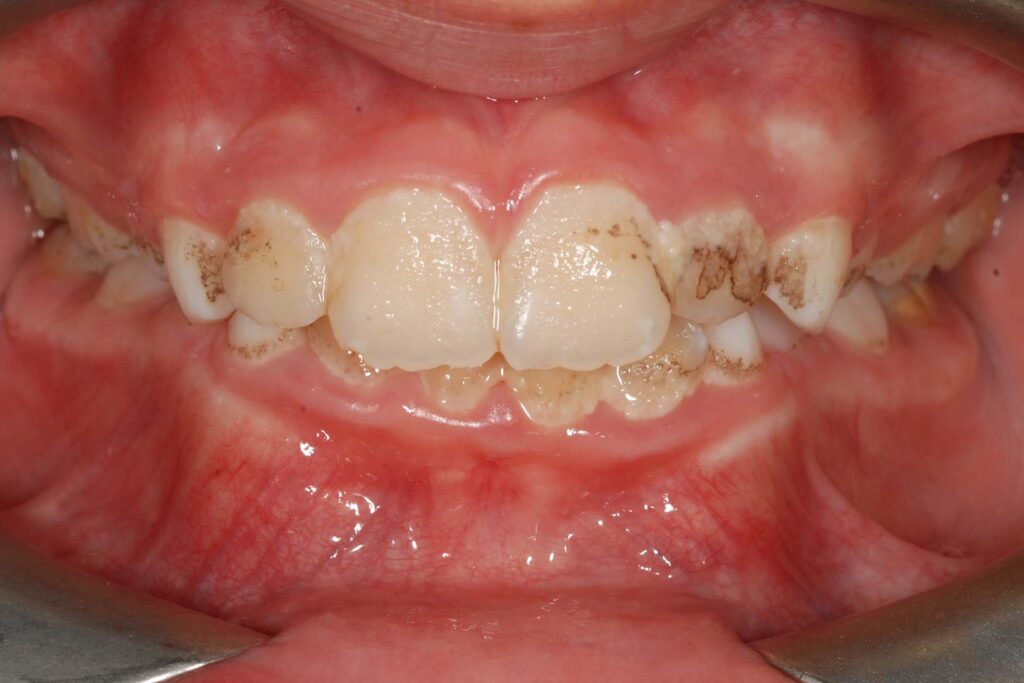Macchie bianche o nere sui denti: cosa sono? Come si trattano? Macchie bianche o nere sui denti: cosa sono? Come si trattano?