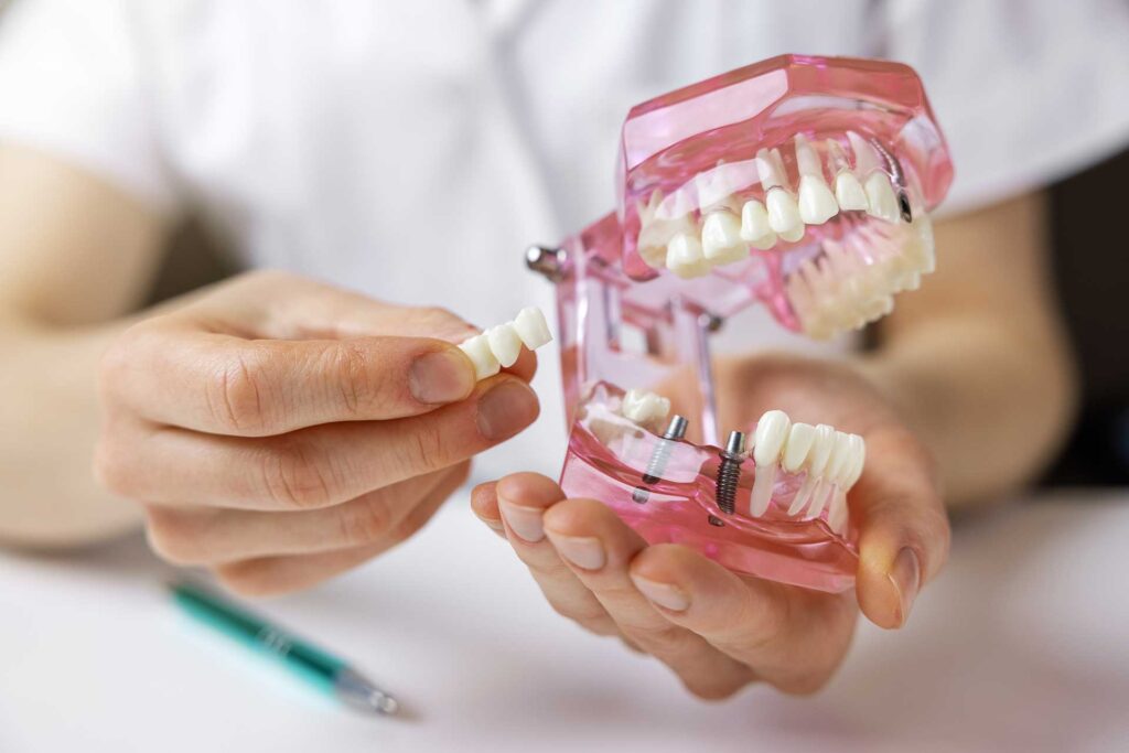 Trapano Extra Lungo Per Impianti Dentali IQ Implants - Irrigazione Esterna, Nuovo